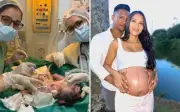 Bebês siameses de Goiás morrem após infecção intestinal grave