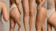 Celulite além do bumbum: mulheres tratam joelhos, braços e quadril