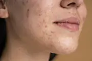 Como cuidar da pele com acne? Especialistas alertam contra receitas caseiras