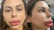 Confeiteira viraliza com reação alérgica a preenchimento labial