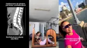 Fisioterapeuta fratura coluna em vídeo de pilates e agora treina para meia maratona