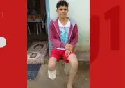 Homem amputa próprio pé para receber R$ 1,5 milhão de seguro e é condenado
