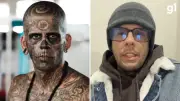 Homem mais tatuado do Brasil segue com remoção facial mesmo com insuficiência renal
