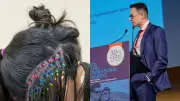 Médico brasileiro Elson Viana publica técnica de transplante capilar em periódico internacional