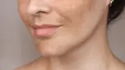 Método inovador trata melasma de dentro para fora e evita efeito rebote