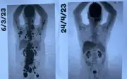 Paciente celebra remissão total do câncer após terapia CAR-T Cell: 'Auge de 13 anos'