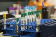 Proteínas no sangue podem prever câncer de pulmão 5 anos antes
