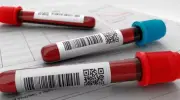 SUS incorpora novo tratamento contra leucemia mieloide aguda