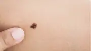 Terapia com prata e anti-inflamatório pode revolucionar tratamento de câncer de pele