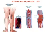 Trombose venosa: varizes aumentam risco em até 5 vezes, alerta estudo