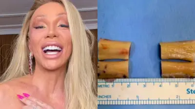 Maya Massafera exibe ossos removidos em cirurgia inédita de redução dos ombros