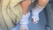 Bebê de 11 meses tem queimaduras de 2º grau após banho em escola no RS