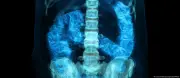 Brasileiros desconhecem exame que detecta câncer de intestino precocemente