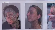 Holandesa remove 250 tatuagens feitas à força por ex-namorado abusivo