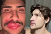 Influenciador 'Ken de CG' internado com infecção grave ao espremer espinha