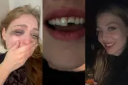 Jovem quebra dente na balada, vai ao dentista de madrugada e volta à festa no PR