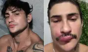 Ken de CG: entenda os riscos de espremer espinha no 'triângulo da morte'