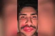 'Ken humano' internado após espremer espinha na 'zona da morte' do rosto