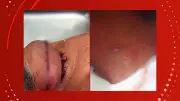 Linha com cerol fere dois motociclistas em Oiapoque; crime causa apagão