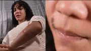 Mulher trans atacada com garrafa quebrada em Rosário relata dor e trauma