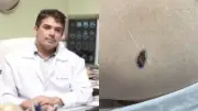 Neurocirurgião morre aos 52 anos de melanoma; entenda os riscos