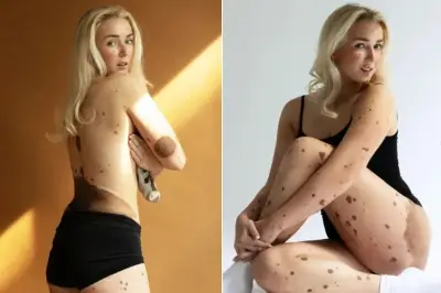 Jovem com manchas raras no corpo ouve sempre: 'caiu na lama?'