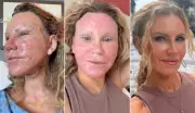 Mulher mostra realidade sem filtro de facelift na Turquia