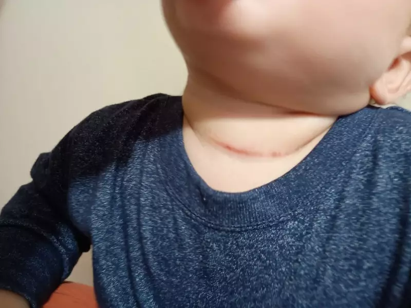 Bebê fica ferido no pescoço após ser atingido por linha chilena: mãe exige fiscalização