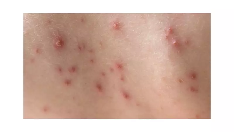 Casos de mpox são confundidos com catapora em escola no Amazonas: FVS explica diferenças